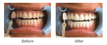 denist 1 Cosmetic Treatment